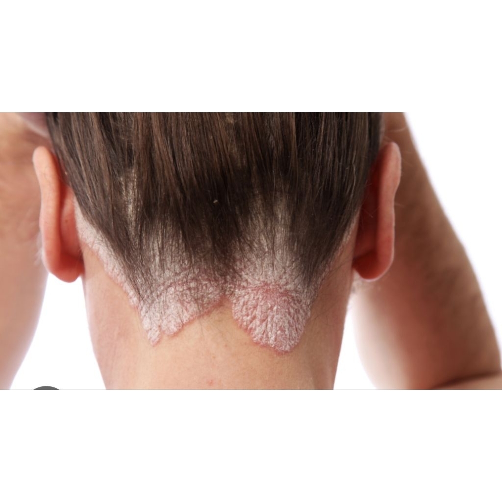 Krim Psoriasis