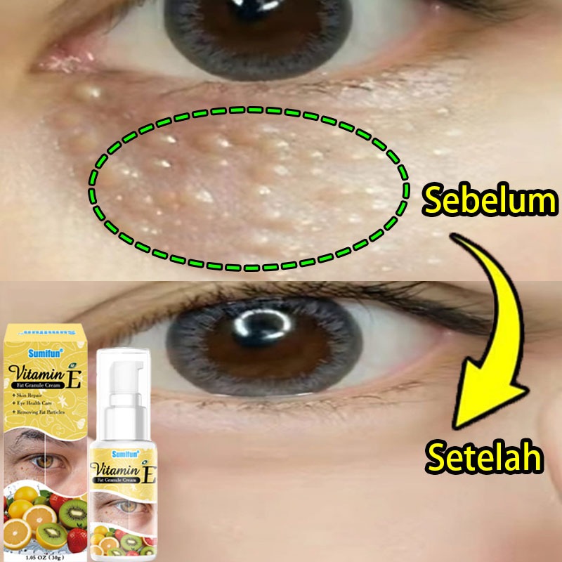 krim penghilang milia Penghilang milia Milia di bawah mata Mata panda Penghilang milia di bawah mata