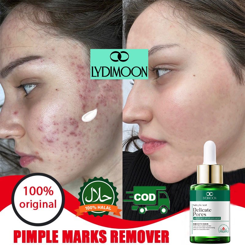 LYDIMOON Serum Asam Salisilat untuk Menghilangkan Jerawat, Krim Penghilang Bekas Jerawat, Salep Luba