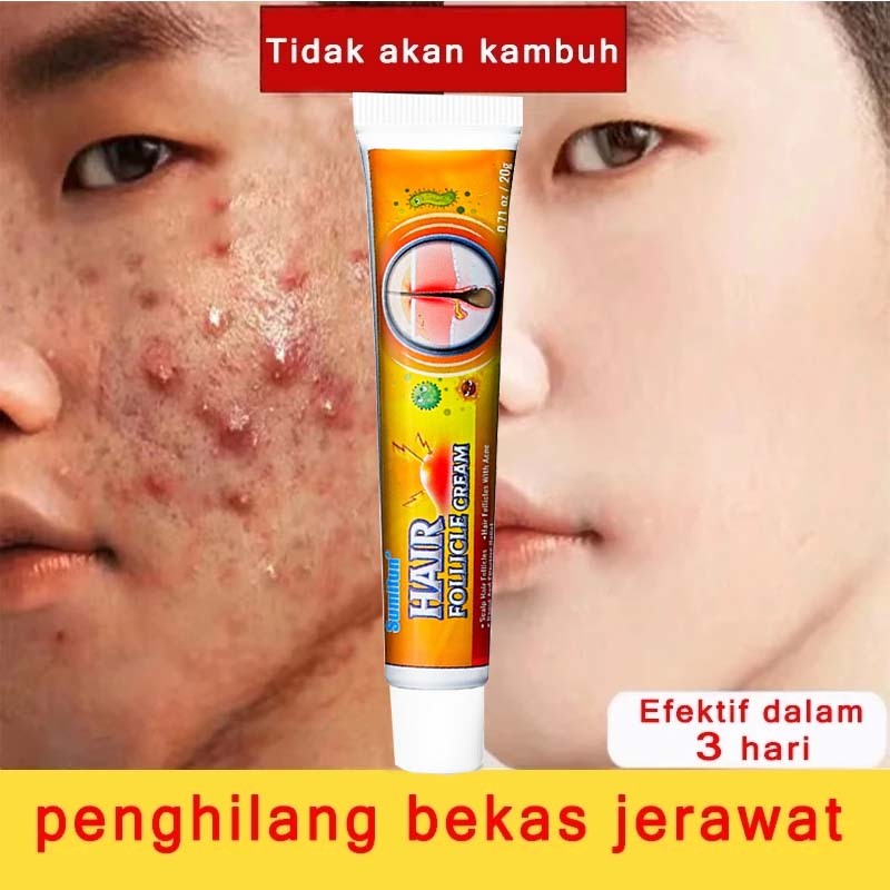 Acne Cream salep Jerawat dan bekas Removal cream Obat jerawat Gel Bekas jerawat Lotion Acne Cream sa