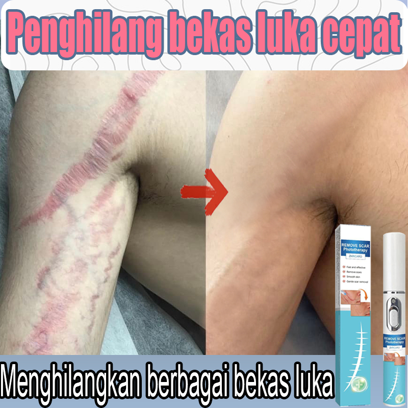 Pena penghilang bekas luka laser cocok untuk menghilangkan bekas luka operasi, bekas luka, penghilan
