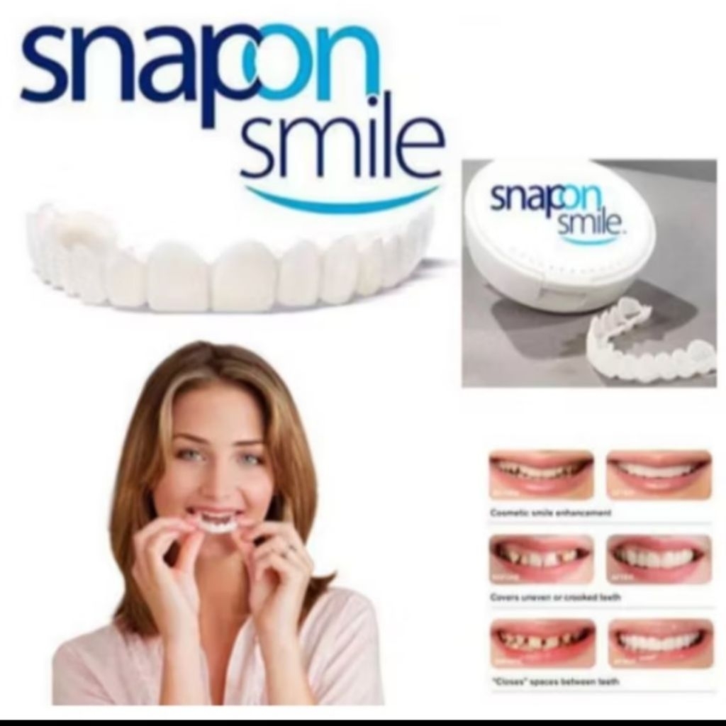Snap On Smile Gigi Merapikan Gigi