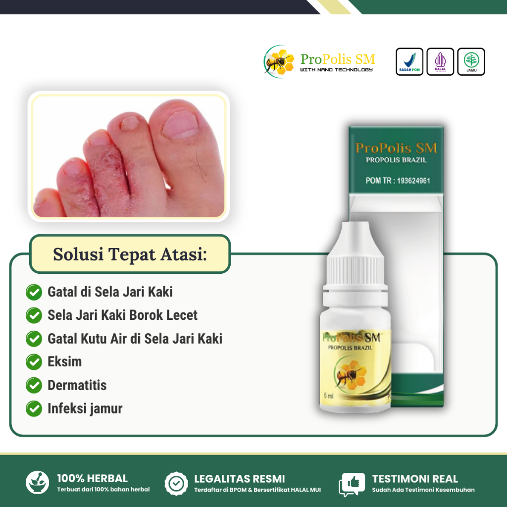 Obat Kutu Air, Obat Gatal di Sela Jari Kaki Tangan Kaki, Obat Kutu Air Untuk Kaki, Obat Kutu Air unt