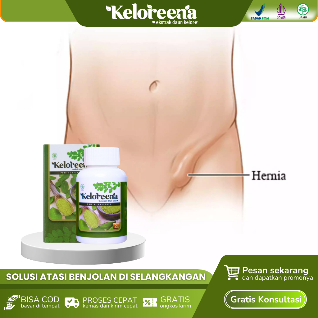 Obat Benjolan Di Selangkangan, Turun Berok, Hernia, Menghilangkan Benjolan Selangkangan - Keloreena