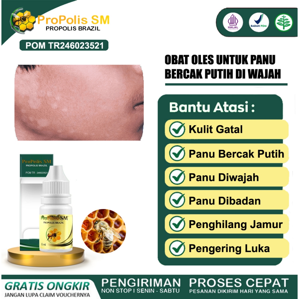 Obat Hapur Kulit, Bercak Putih Di Wajah, Penghilang Panu Di Wajah, Obat Oles  Penghilang Balas Bogo 