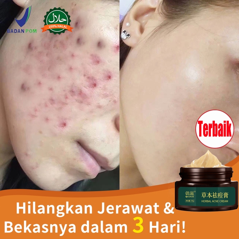 Krim Penghilang Jerawat BPOM QIANZI – Obat Totol Jerawat Ampuh / Mengurangi Jerawat Batu & Bruntusan