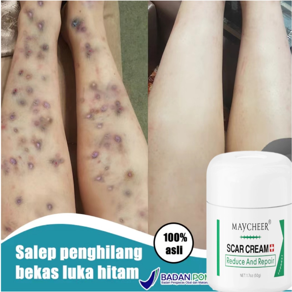 Salep bekas luka penghilang bekas luka Penghilang bekas luka hitam koreng menghilangkan bekas luka o