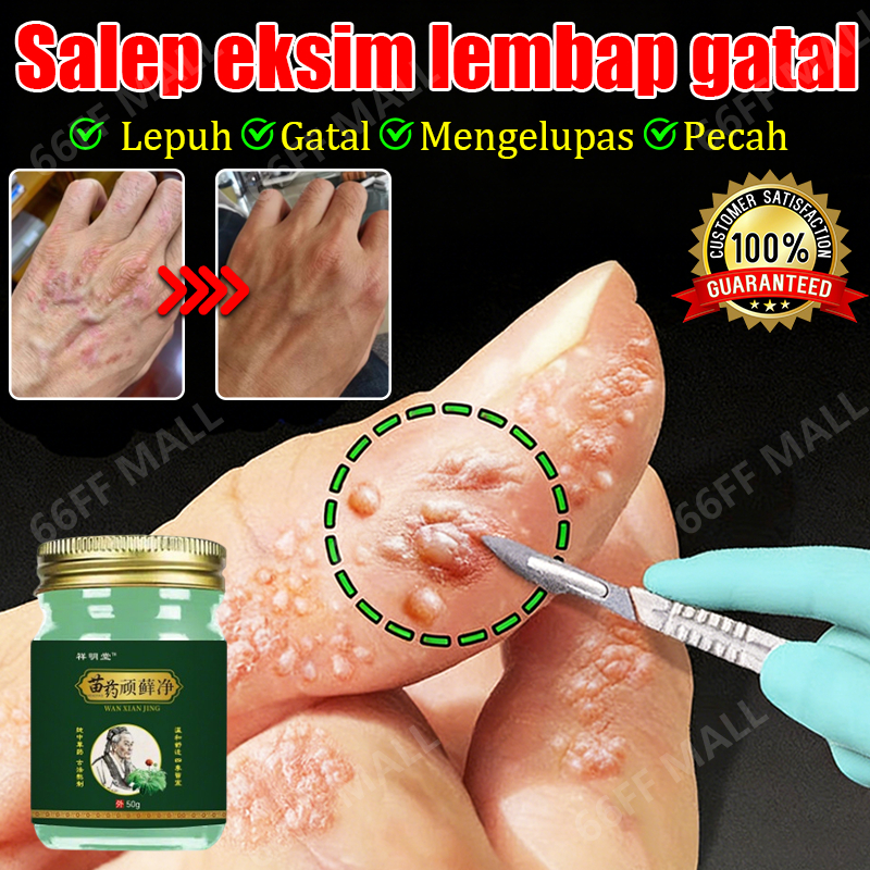 salap gatal kulit yang ampuh salep eksim obt gatal seluruh badan obat gatal selangkangan salep jamur