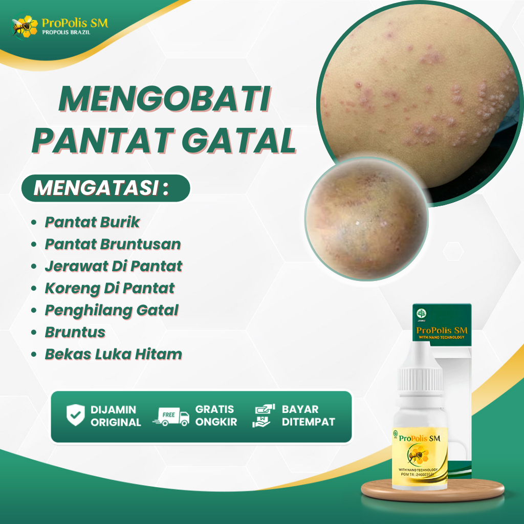 Obat Pantat Gatal, Obat Pantat Burik, Obat Pantat Bruntusan, Obat Jerawat Di Pantat, Obat Koreng Di 