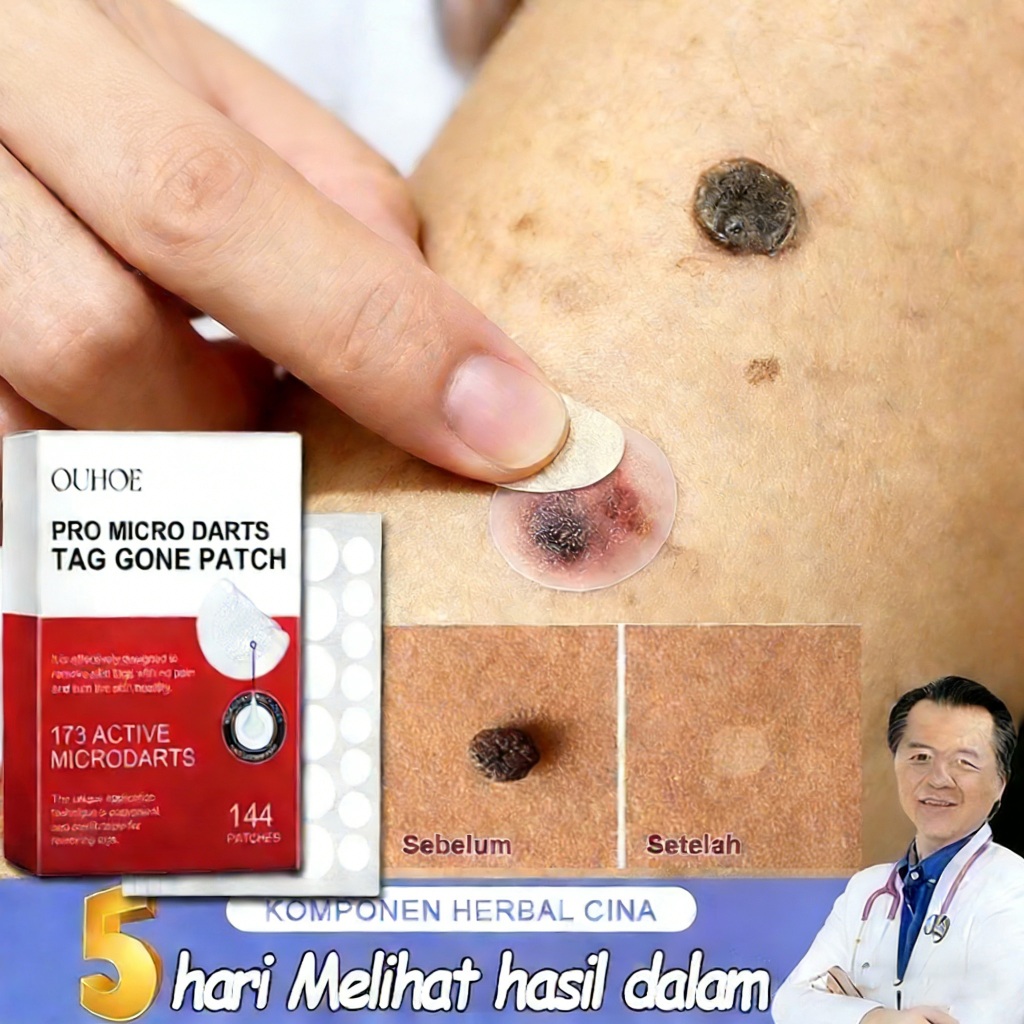 Stiker Penghilang Kutil Dan Tahi Lalat 144pcs Wart Remover Patch Penghilang Tahi Lalat Di Wajah Peng