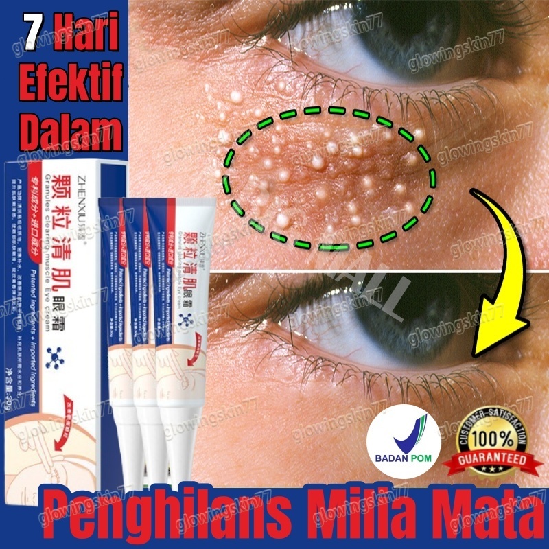 30g Krim Penghilang Milia Krim Mata Agen Penghilang Milia Obat Milia untuk Bawah Mata Krim Milia Pen