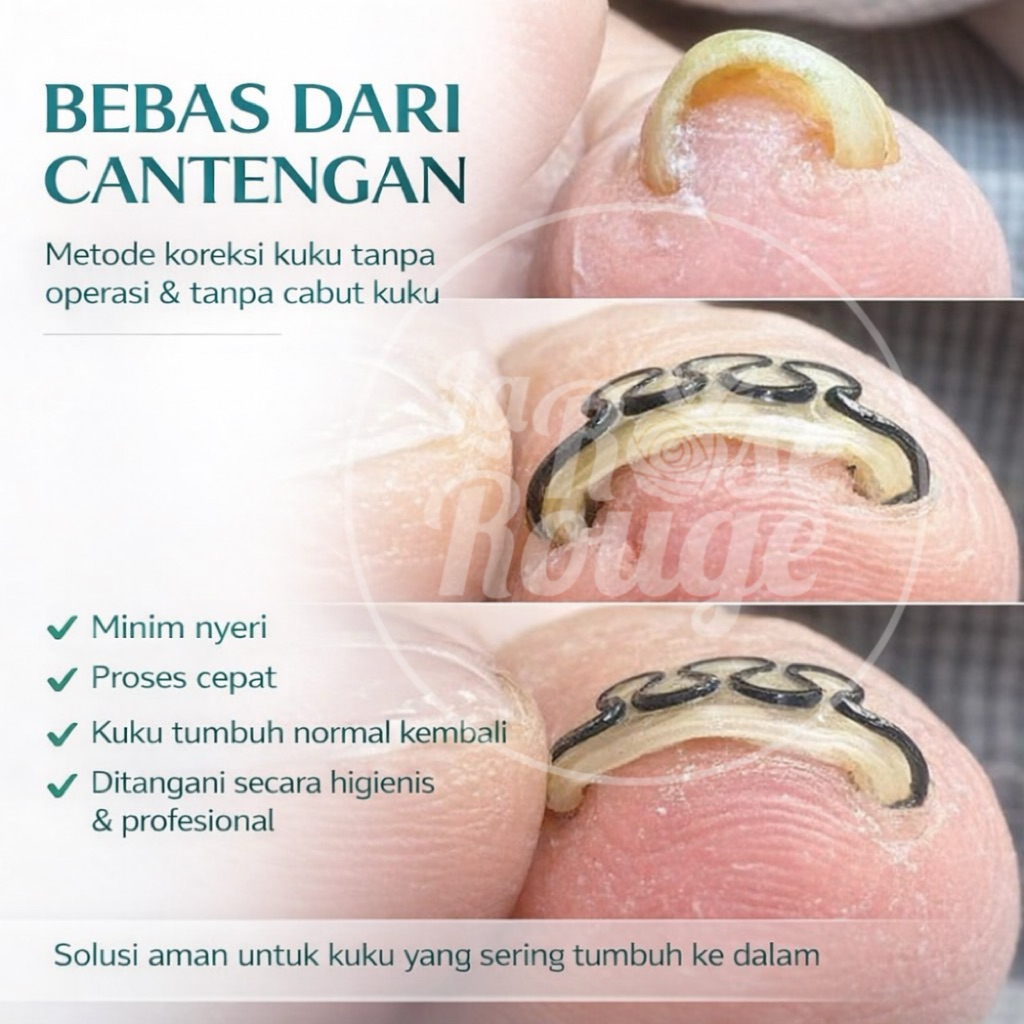 Alat Korektor Cantengan Kuku Kaki – anti cantengan & penghilang cantengan Kuku