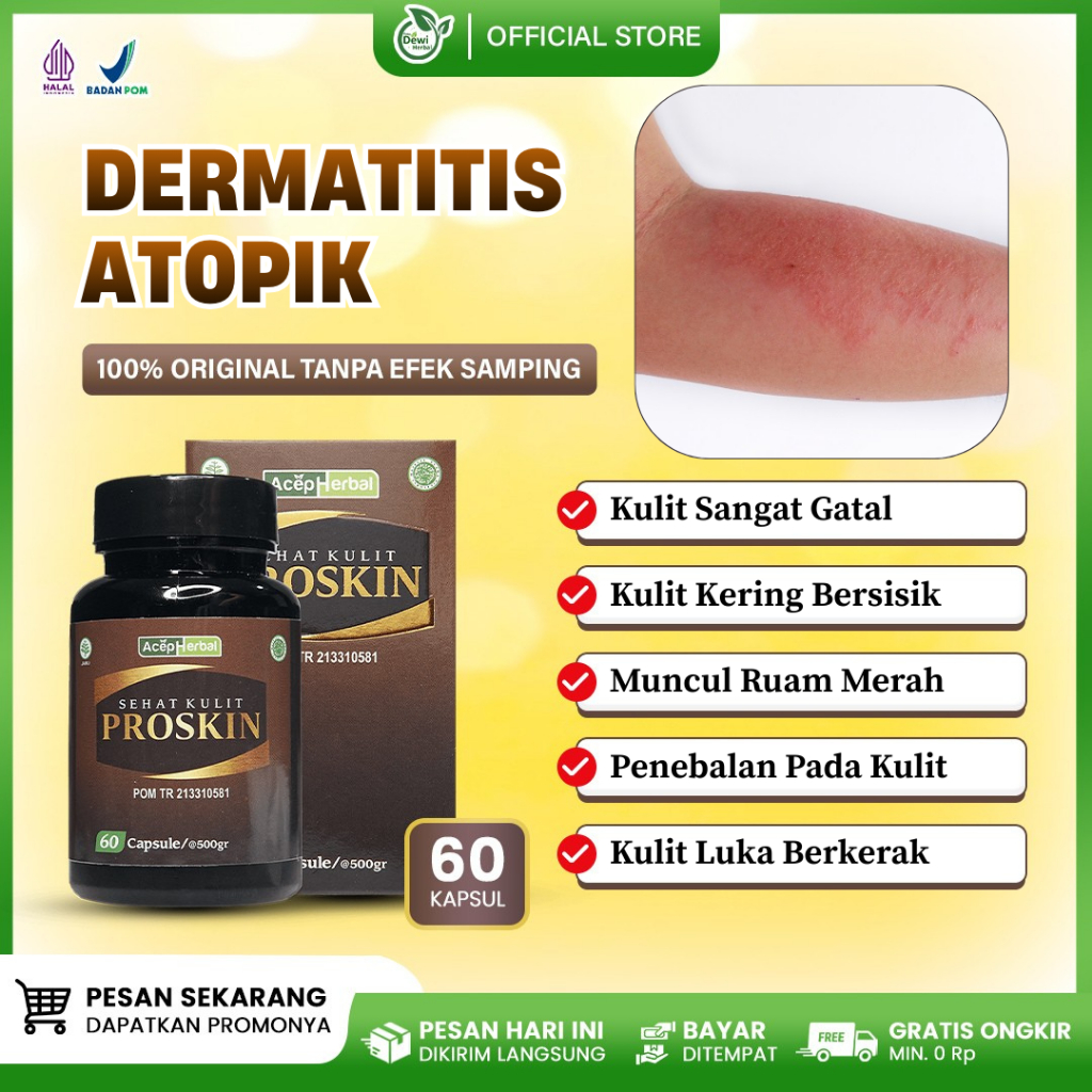 Obat Dermatitis Atopik, Eksim, Kulit Sangat Gatal, Kulit Kering Bersisik, Ruam Merah Di Lipatan Siku