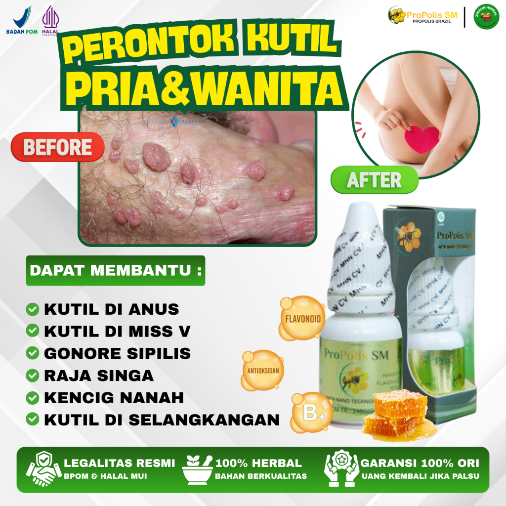 Propolis SM - Kutil Kelamin HPV, Perontok Kutil Kelamin Kutil Anus Pria & Wanita Bintik Benjolan Mis