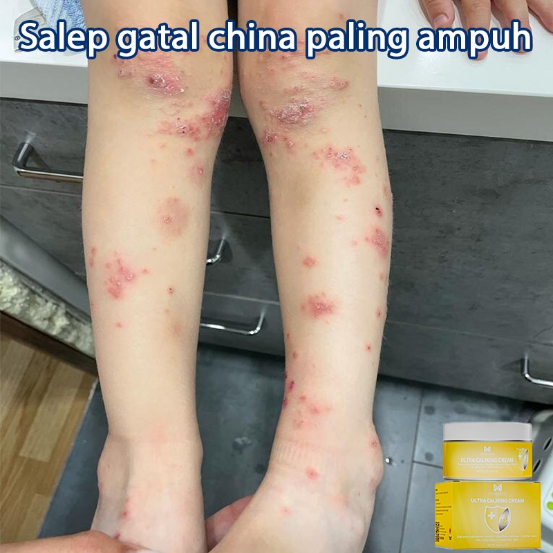 Salep eksim kering dan gatal salep china gatal paling ampuh salap gatal kulit yang ampuh 20g obt sel