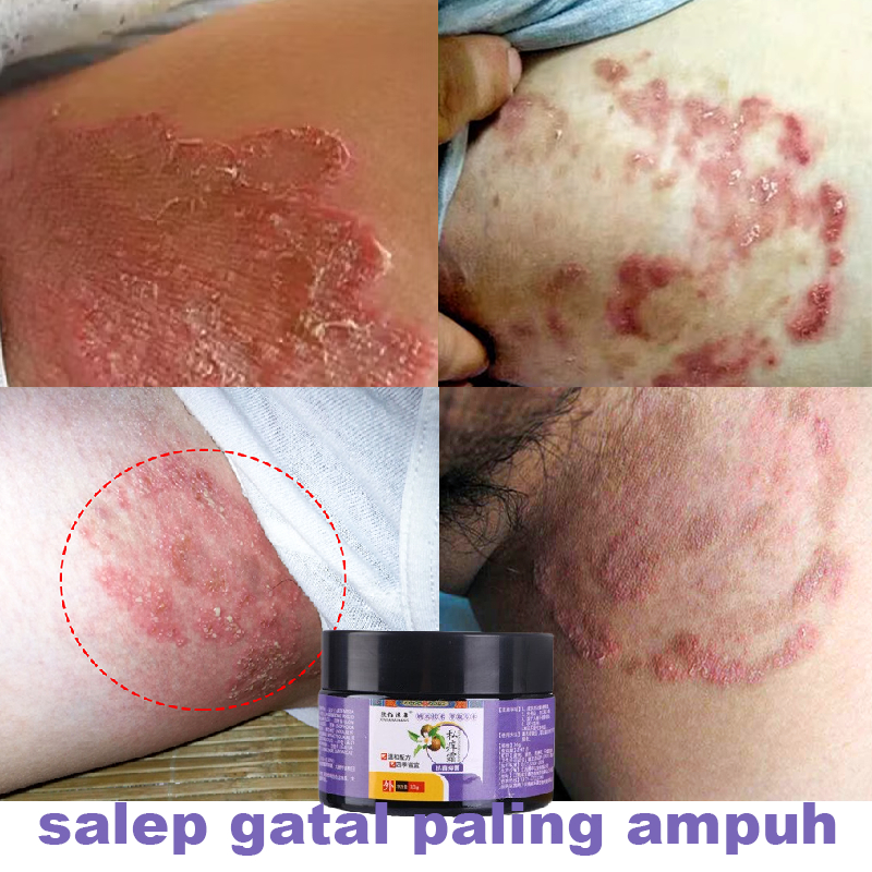 Obat gatal selangkangan salep gatal selangkangan salep china gatal paling ampuh salep selangkangan g