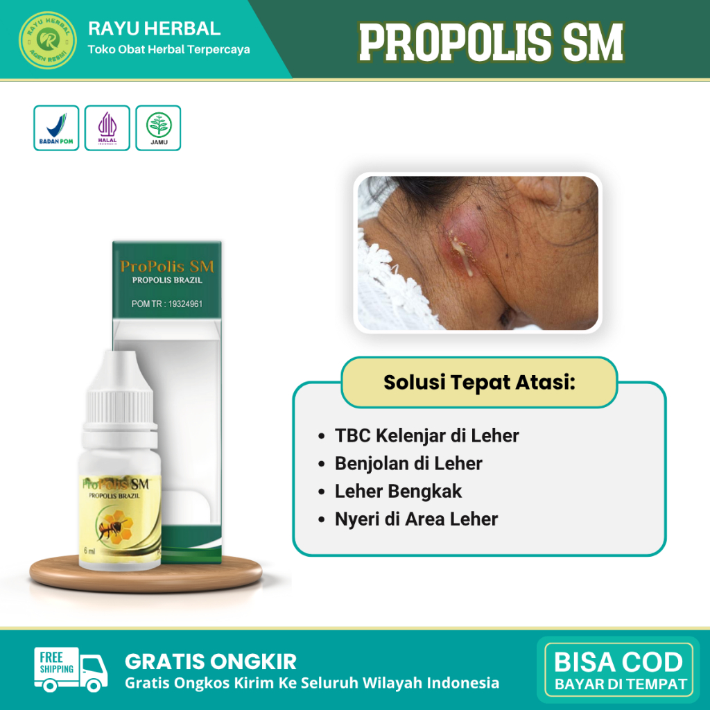 Obat TBC Kelenjar di Leher, Benjolan di Leher, Gondok Beracun, Kelenjar Tiroid, Kelenjar Getah Benin