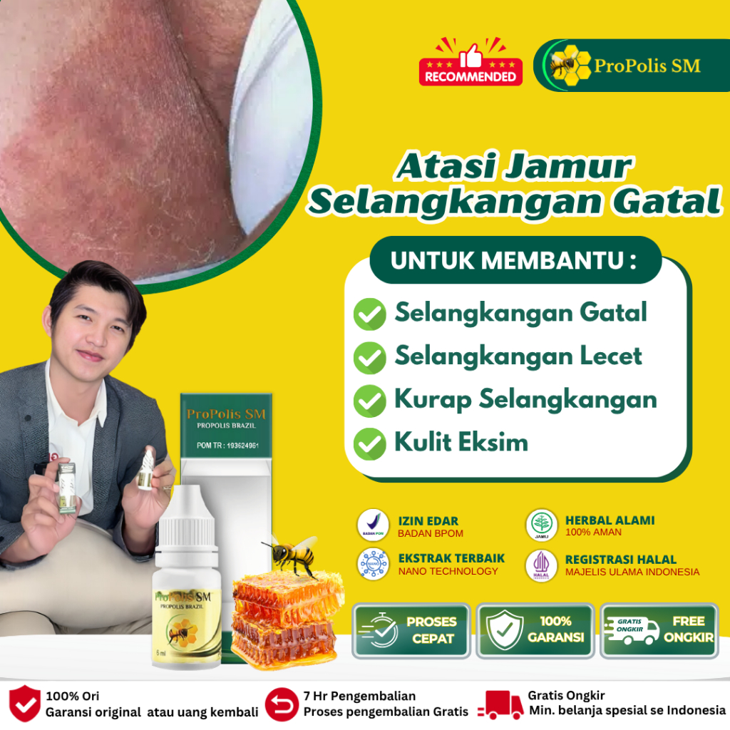 Obat Salep Gatal Selangkangan, Selangkangan Berjamur, Selangkangan Paha Gatal Beruntusan, Selangkang
