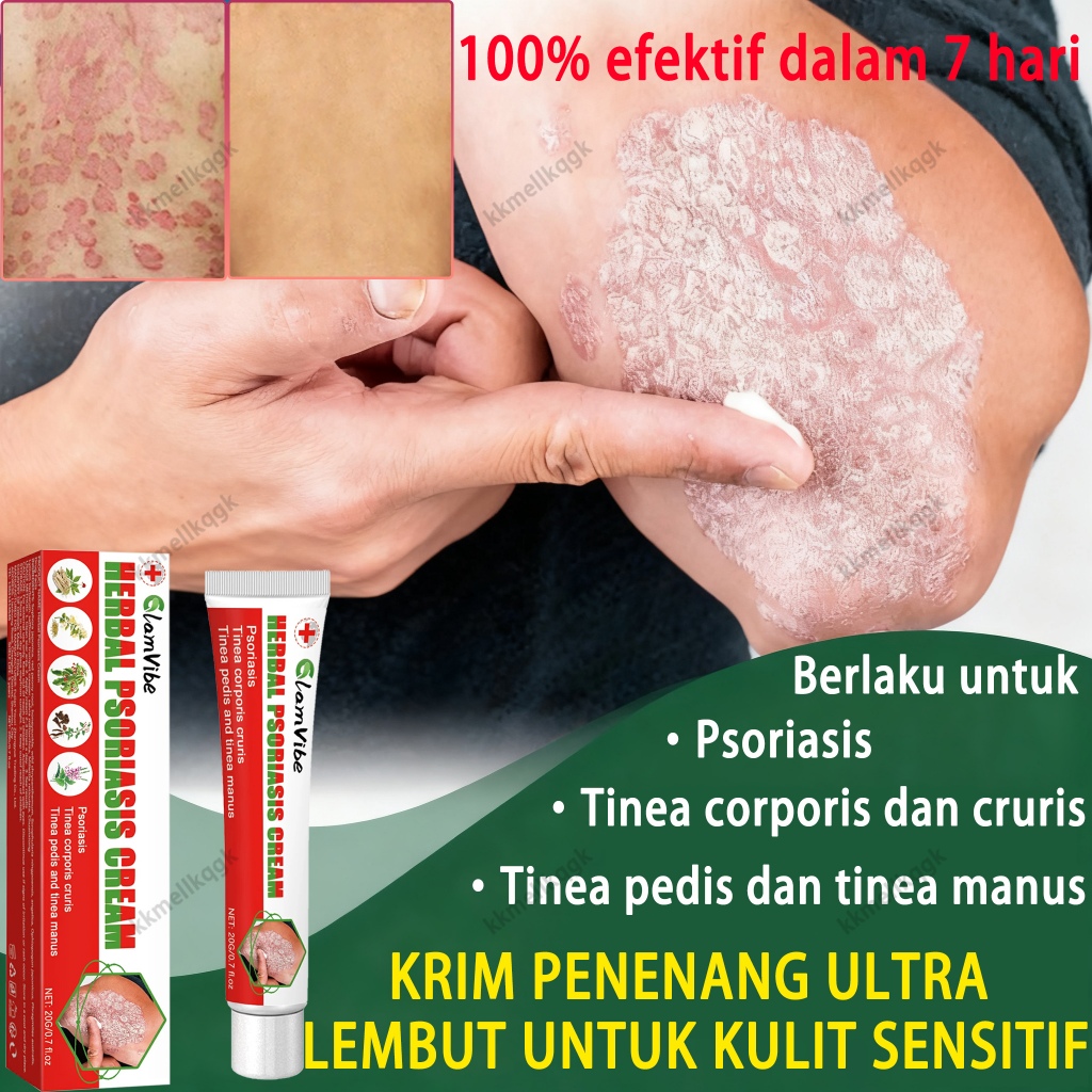 Krim Perbaikan Psoriasis 20g, salep anti-gatal, efektif meredakan gatal yang disebabkan oleh psorias