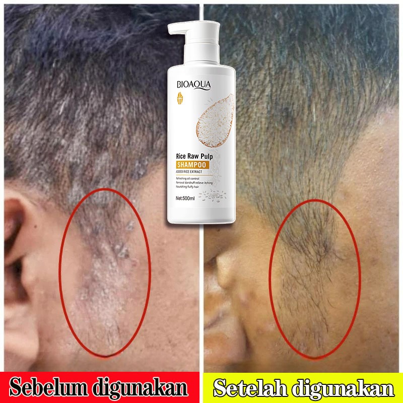Shampoo Anti Ketombe500ML Shampo Sampo Ketombe Sampo Anti Ketombe Obat Ketombe Ampuh Shampo Ketombe 