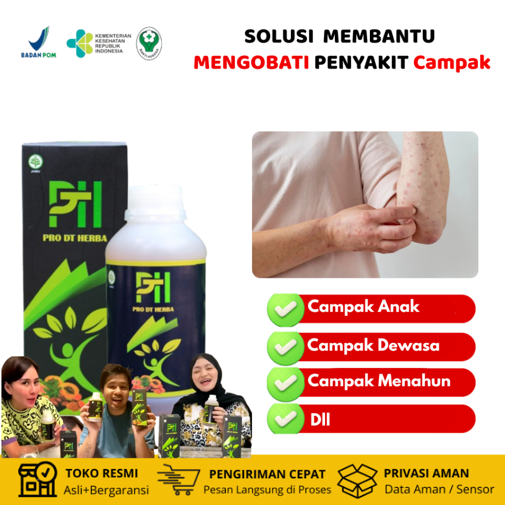 Obat campak mapoh penghilang bekas campak, herpes, cacar, anti radang dan iritasi untuk anak dewasa 