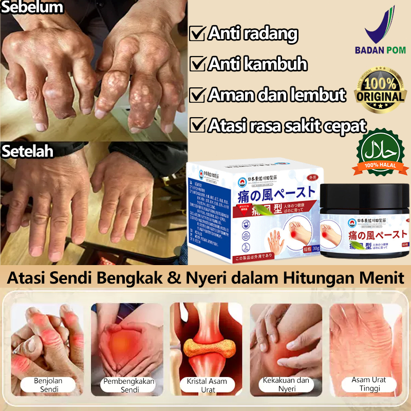 Salep asam urat paling ampuh Salep nyeri sendi Salep benjolan cepat 30g Salep bunion pain relief Ori