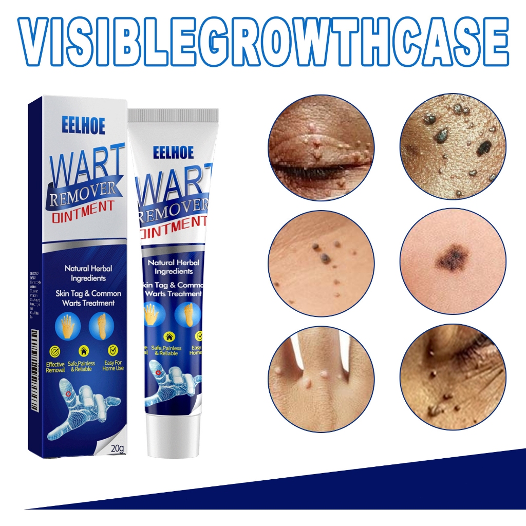 Eelhoe Herbal Cream Penghilang Kutil Tahi Lalat Ampuh 20g Wart Remover Cream
