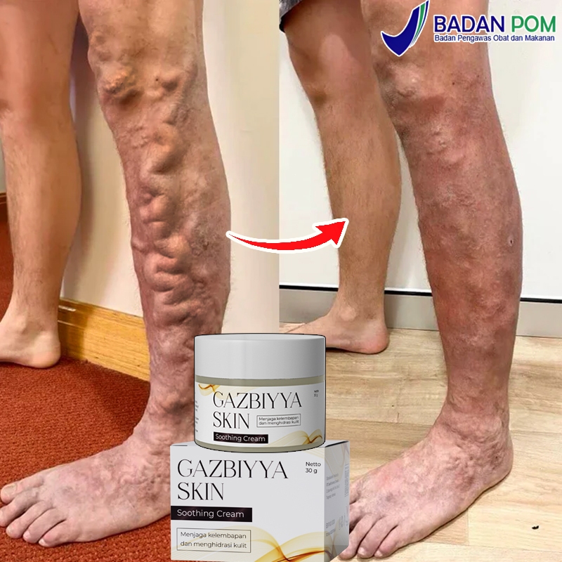 Obat varises Varicose veins cream Cream varises paling ampuh original Salep varises 30g obat varises