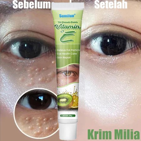 krim penghilang milia syringoma xanthelasma butiran lemak sekitar mata Milia remover cream 20g obat 