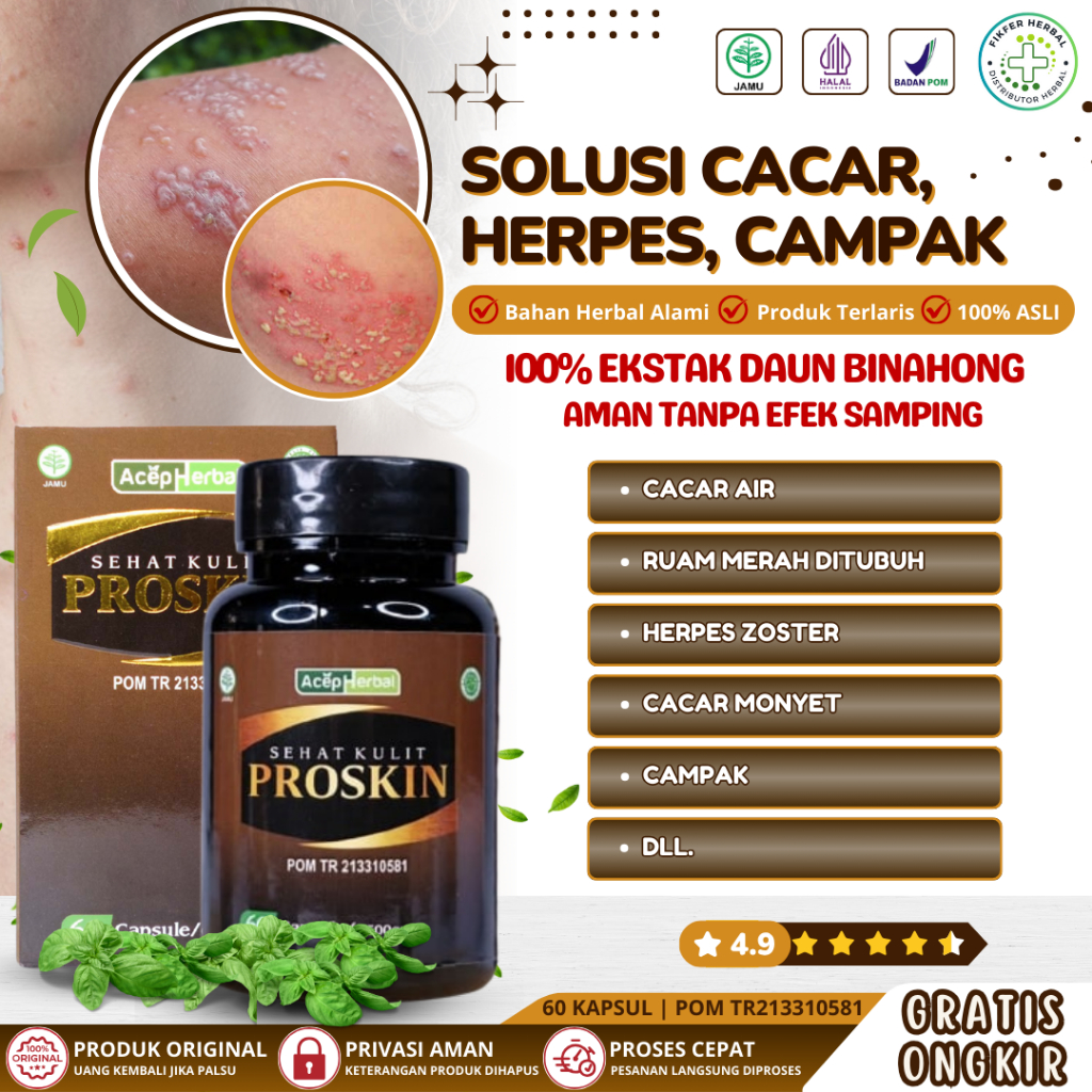 Obat Cacar, Obat Cacar Air, Cacar Api, Cacar Ular, Obat Cacar Monyet, Obat Penghilang Cacar, Obat Va