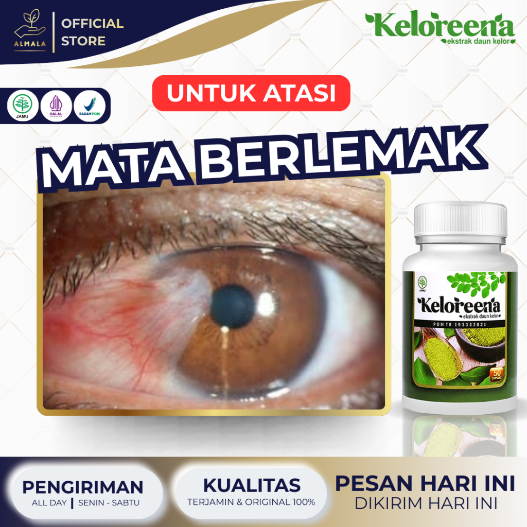 Obat Atasi Mata Berlemak, Selaput Putih di Mata, Pterigium, Pembersih Mata, Vitamin Mata - KELOREENA