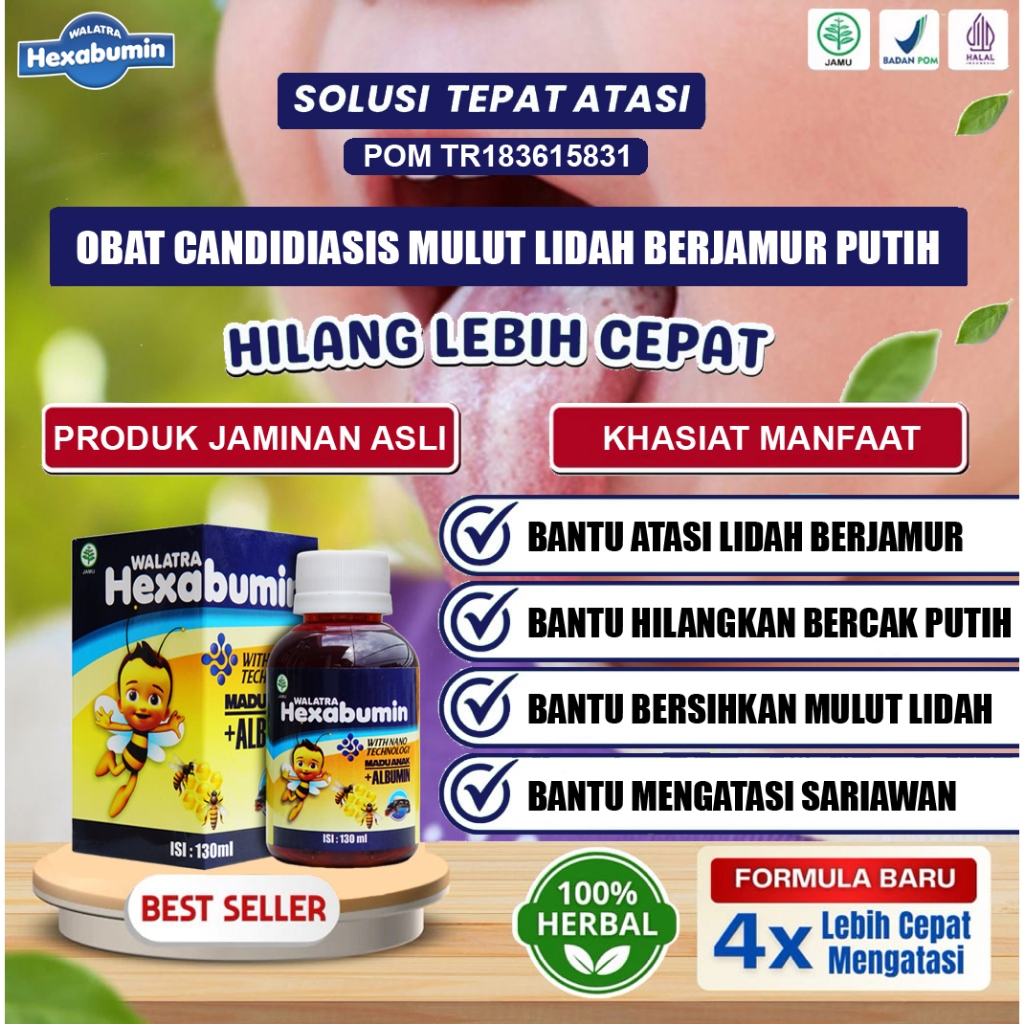 Obat Candidiasis Mulut, Lidah, Jamur Lidah, Mulut Berjamur, Becak Putih Atau   Kuning Di Lidah, Aman