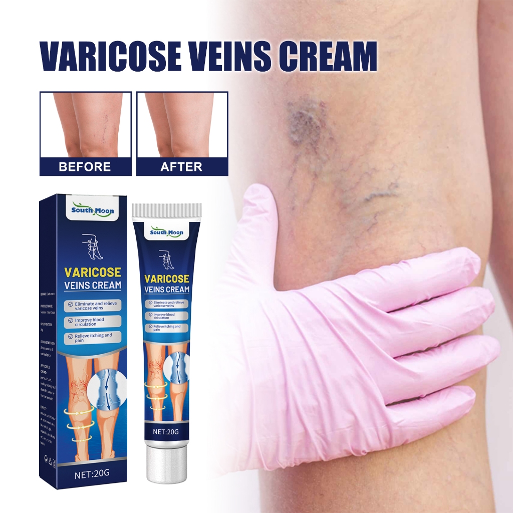 South Moon Varicose Veins Cream 20g  Obat Varises Paling Ampuh obat varises di kaki dan betis paling