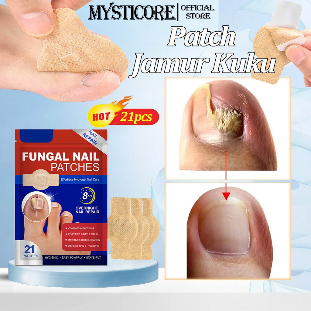 MYSTICORE Obat Jamur Kuku obat Kuku Cantengan Plester Kuku Kaki Obat Kuku Rusak Pembersih Kuku Kaki 