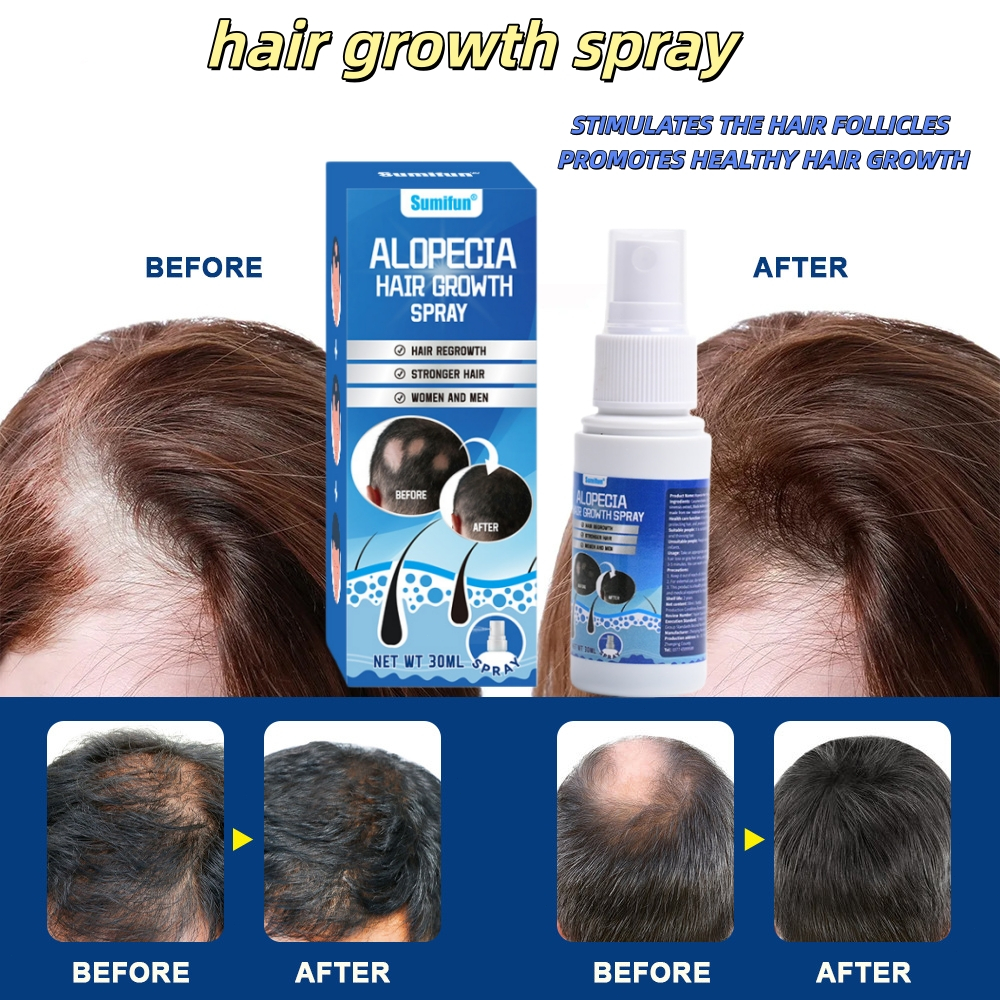 Obat Alopecia Areata Krim Penumbuh Rambut 30g - Atasi Alopecia Areata, Rambut Rontok, dan Kebotakan 