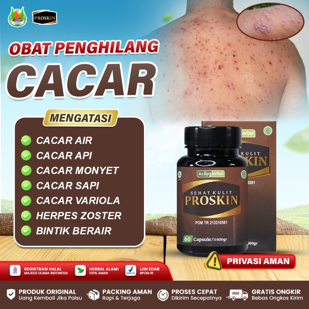 Obat Cacar Air Anak dan Dewasa, Cacar Api, Cacar Monyet, Herpes, Penghilang Bekas Cacar - Proskin