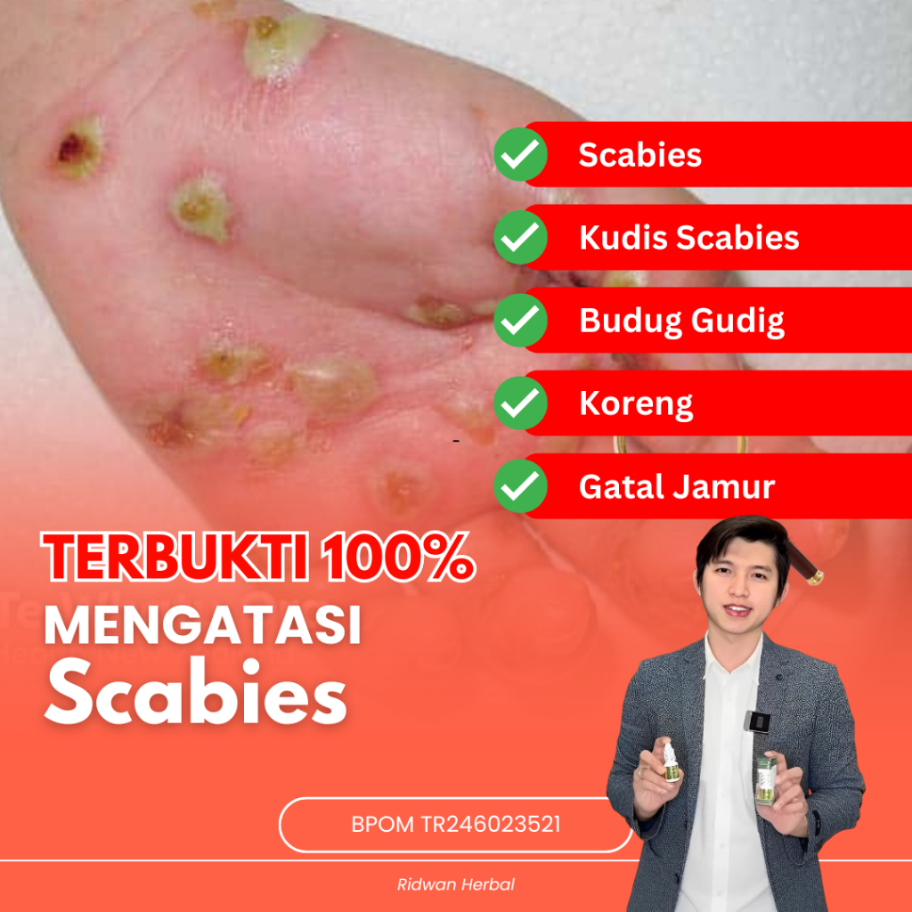 Obat Scabies Manusia, Obat Kudis Scabies, Obat Kudis Budug Gudig Budukan, Obat Pembasmi Kudis Skabie