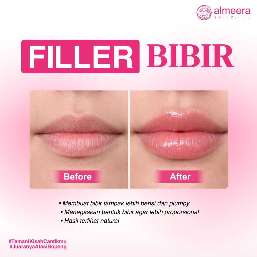 Voucher Filler Bibir di Almeera Skin Clinic