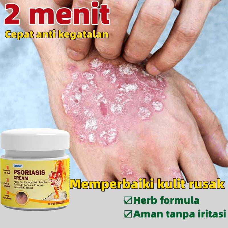 Obat gatal Obat eksim Obat kurap RACIKAN JEPANG Salep psoriasis Salep eksim 20g Obat kurap paling am
