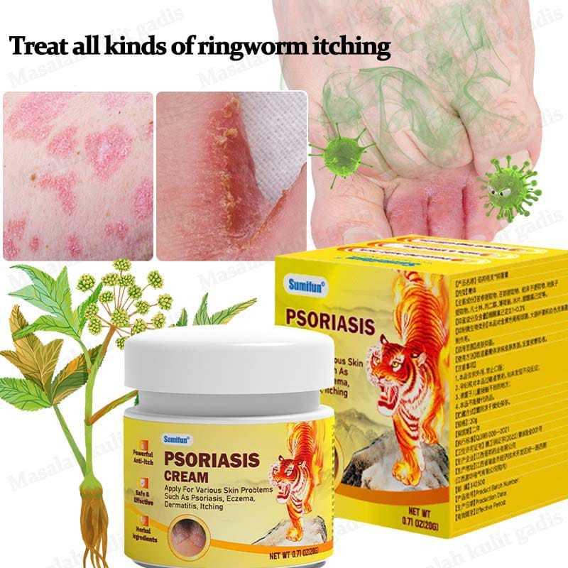 Obat gatal Obat eksim Obat kurap RACIKAN JEPANG Salep psoriasis Salep eksim 20g Obat kurap paling am