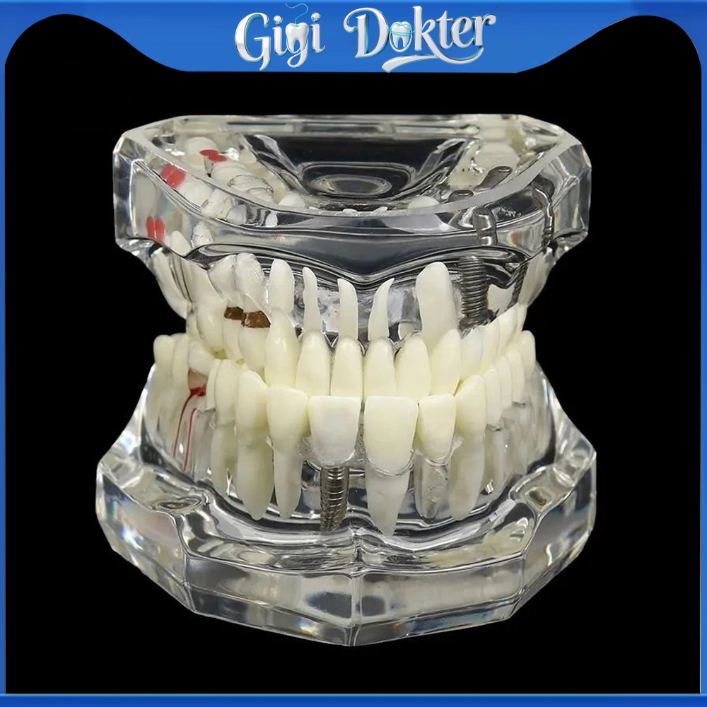 Model study gigi edukasi transparan studi implant phantom crown karies bridge bening impaksi model g