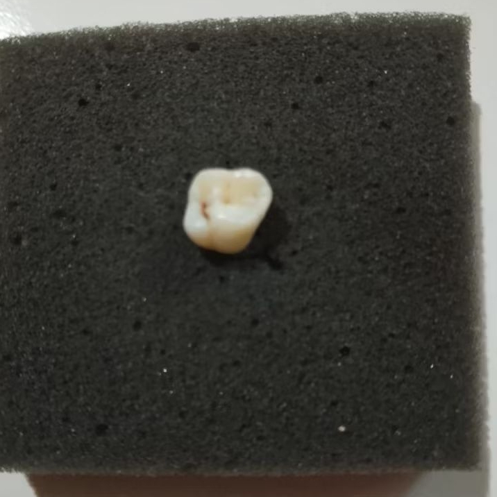 gigi molar sulung