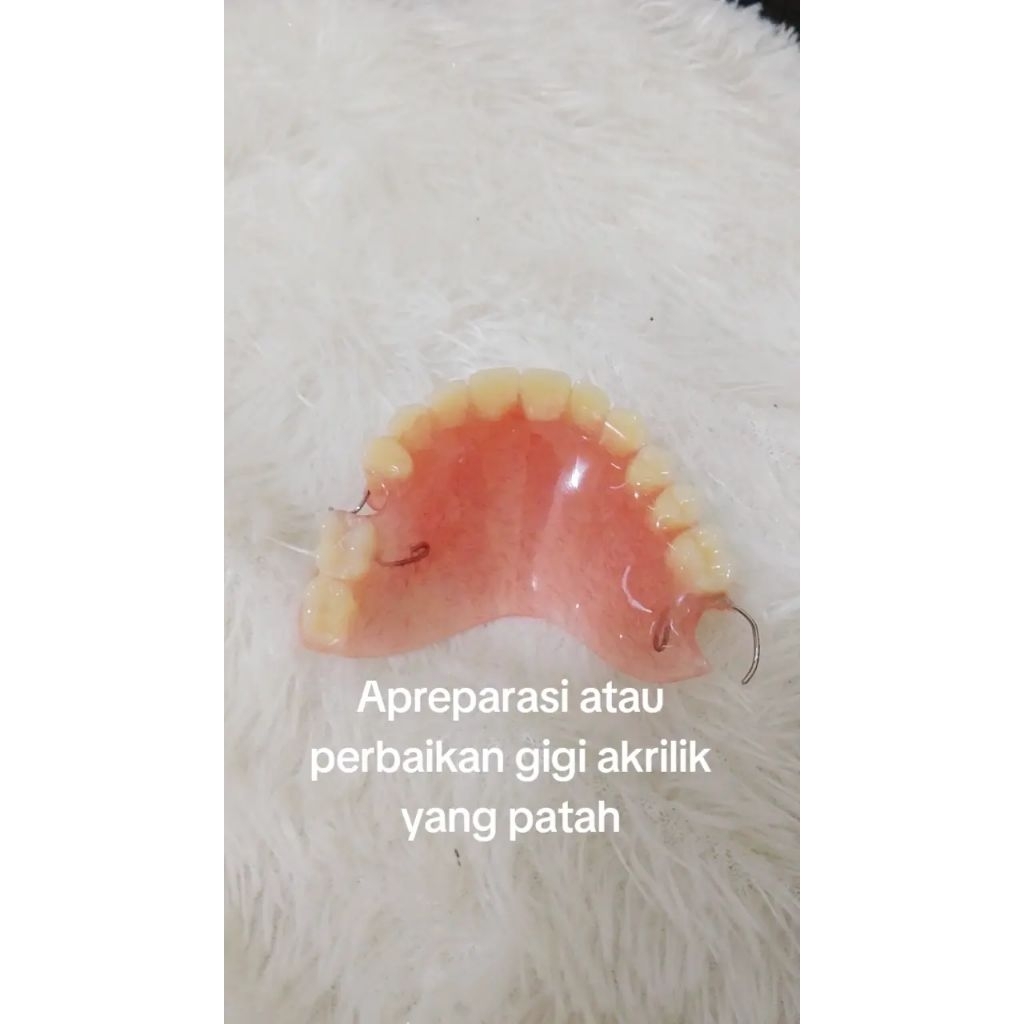 penambahan gigi palsu akrilik 1 gigi