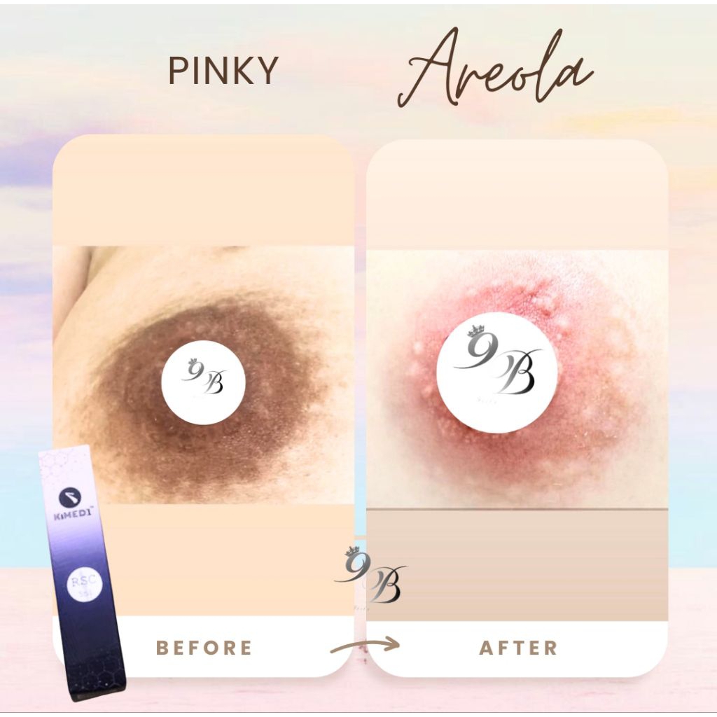 Areola, Miss V, Lip Pink Cream Kimedi RSC RPL 3BS BSC