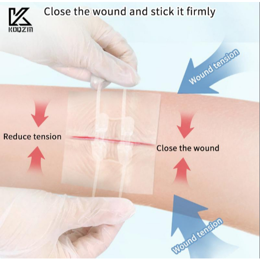 2 Buah Plester Penutup Luka dengan Tali Elastis, Jahitan Cepat, Plester Hemostatik, Perawatan Kulit,