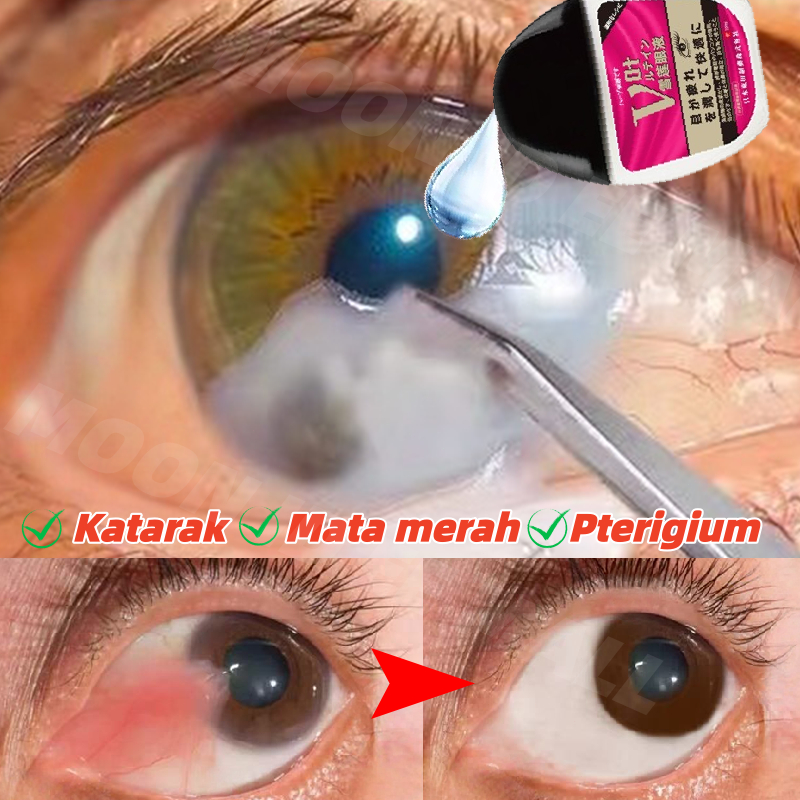 Obat Tetes Mata Obat Mata Katarak Obat mata minus Tetes Mata Herbal Pengobatan Mata Kering Mata bura