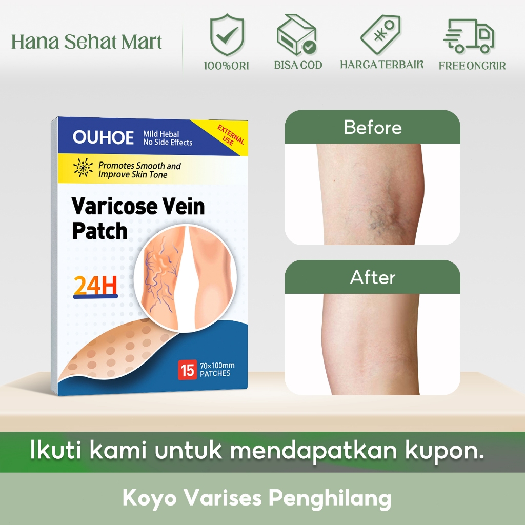 OUHOE Koyo Varises Penghilang 15pcs Penghilang Varises Meredakan Kaki Cacing Tanah Pembuluh Darah Te