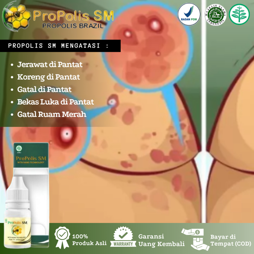 Propolis SM - Obat Jerawat di Pantat, Koreng di Pantat, Gatal di Pantat, Bekas Luka di Pantat, Obat 