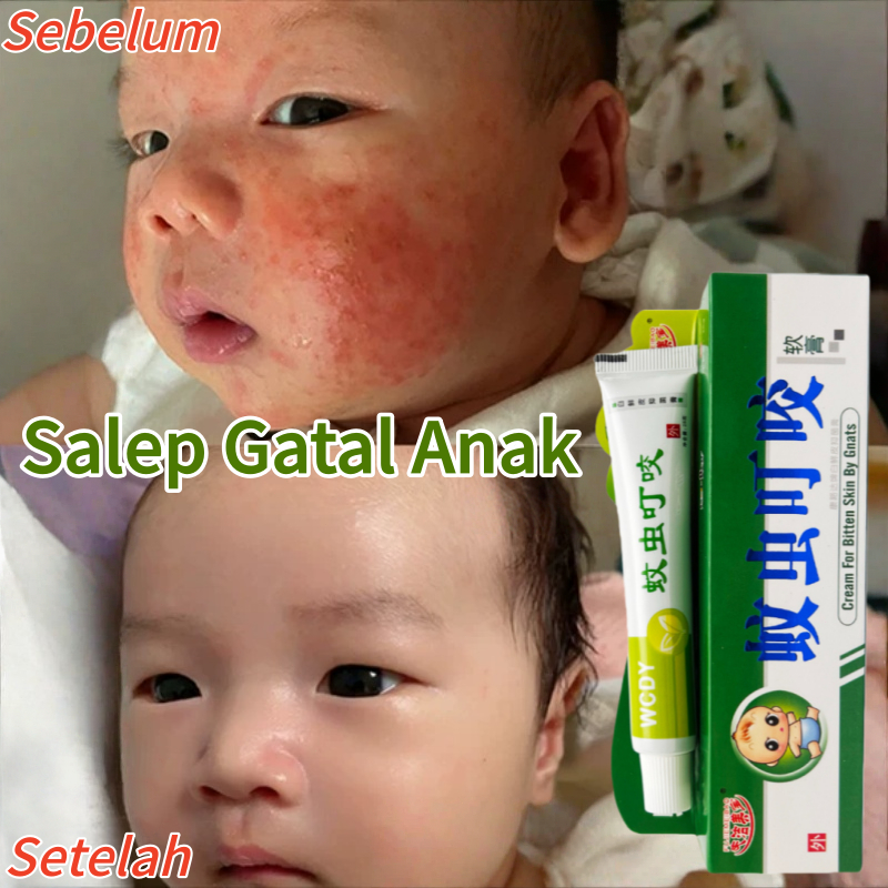 Salep gatal anak Salep biang keringat untuk bayi Salep panu anak di wajah Salep gatal anak paling am