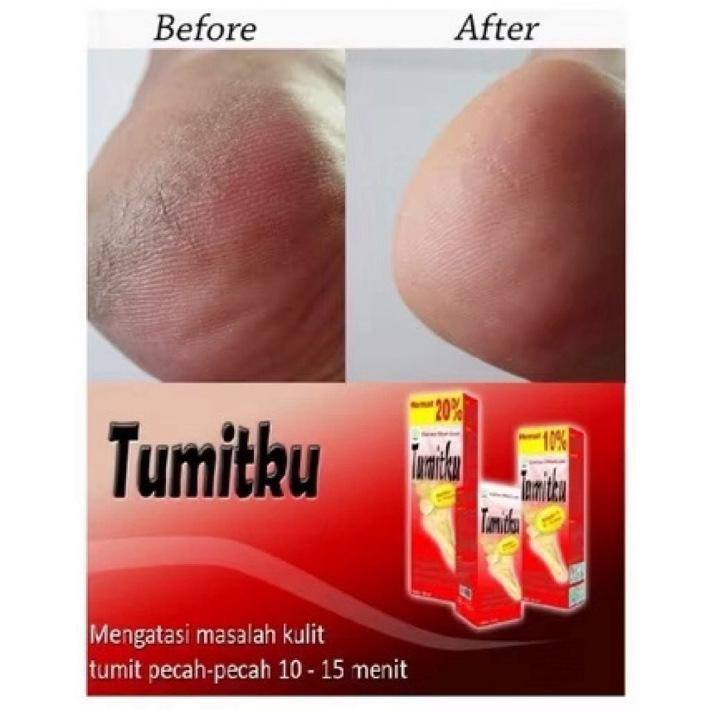 Tumitku Obat kaki pecah pecah &Kapalan |Tumitku Pembersih Kaki Kapalan & Kering|Tumitku BPOM Origina